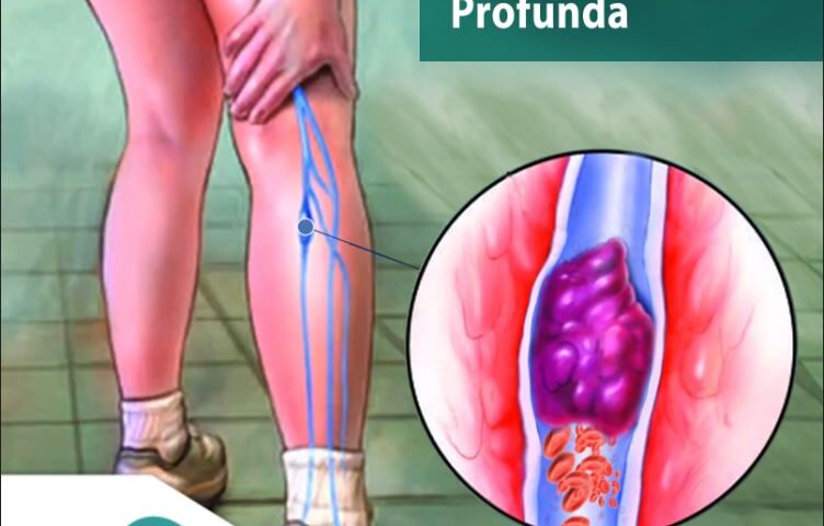 Trombose Venosa Profunda