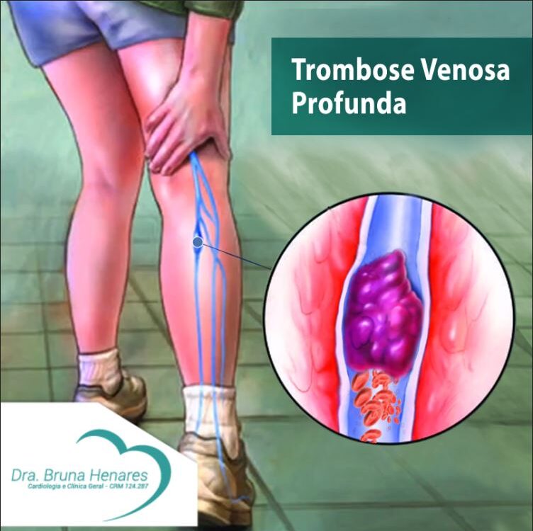 Trombose Venosa Profunda