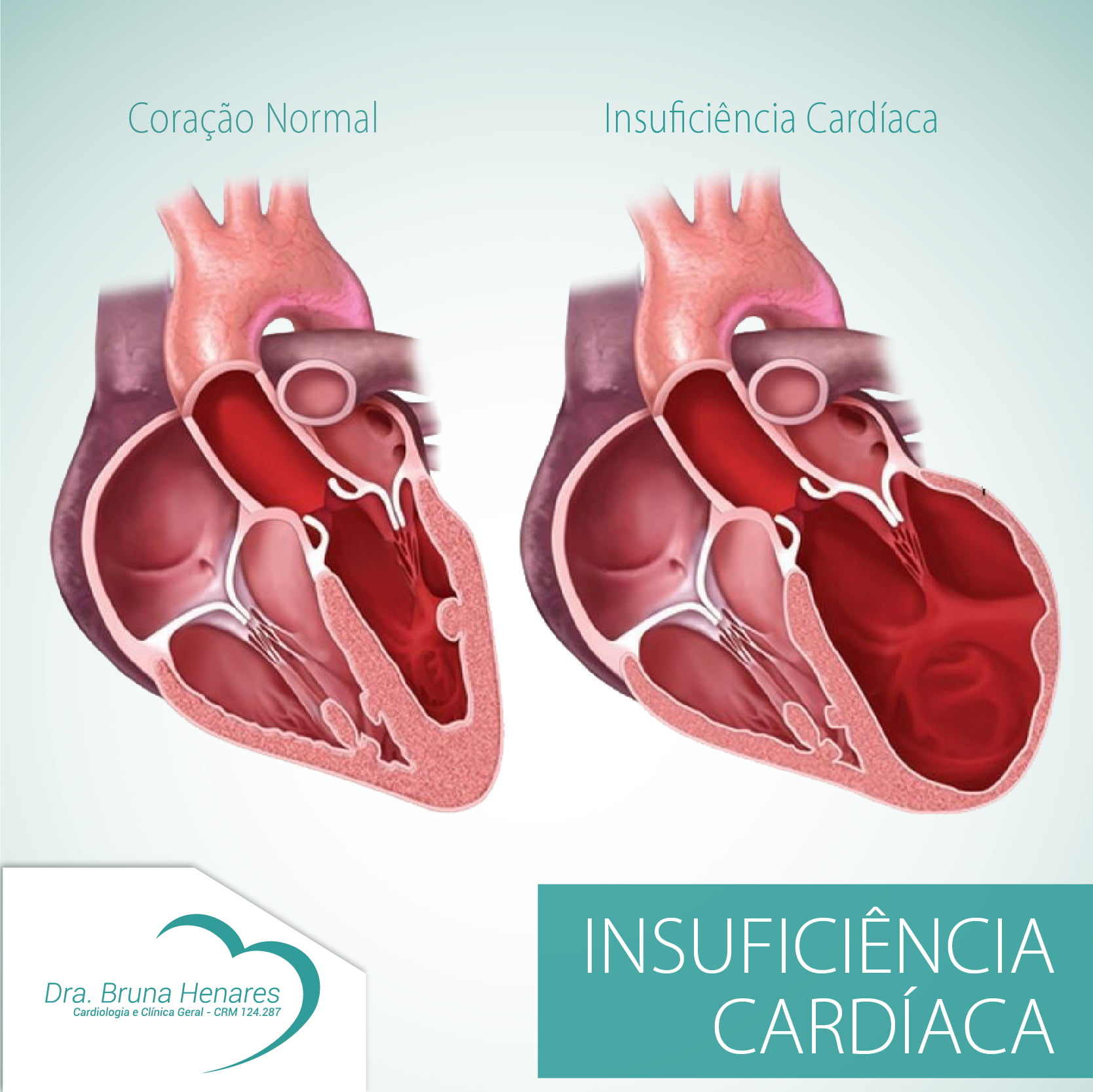 Insuficiência Cardíaca Fique Atento! - Dra. Bruna Henares