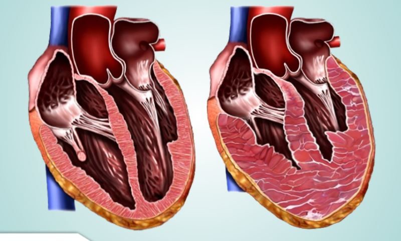 Miocardiopatia Hipertrófica