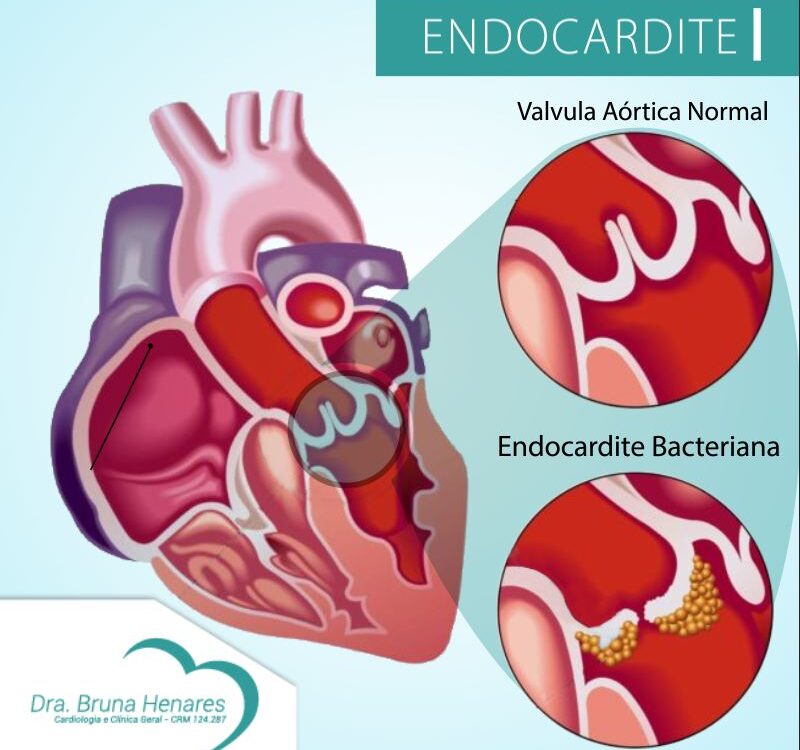 Endocardite