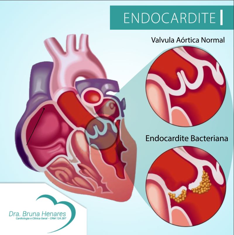 Endocardite