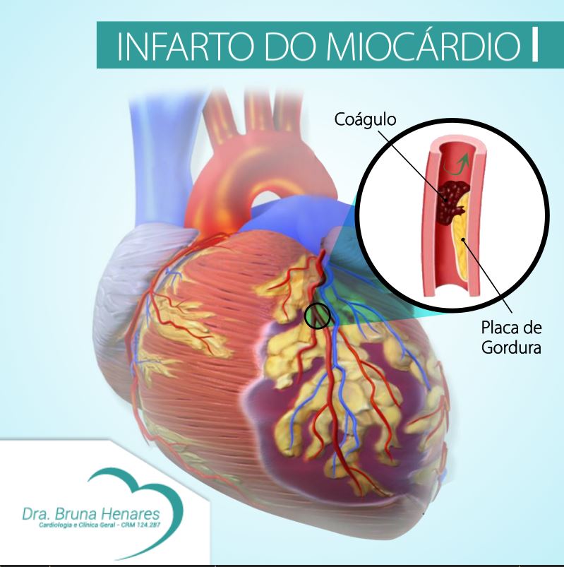 Infarto Ou Enfarte Do Mioc rdio HXYIMD