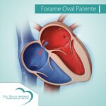 Forame Oval Patente