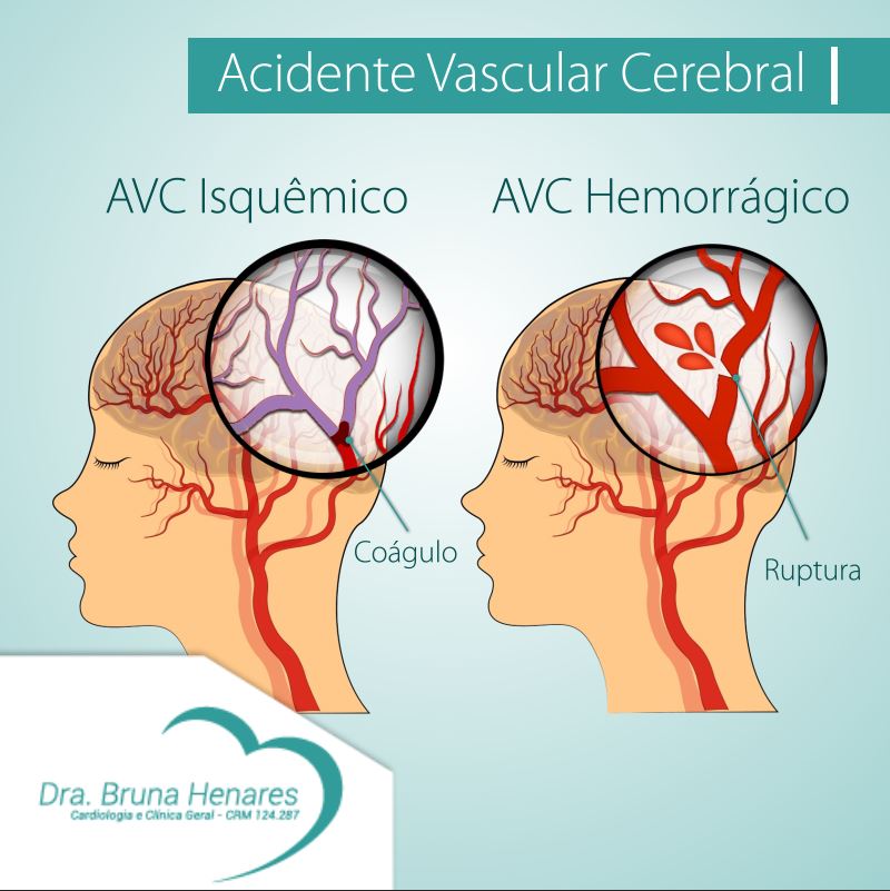 Acidente vascular cerebral