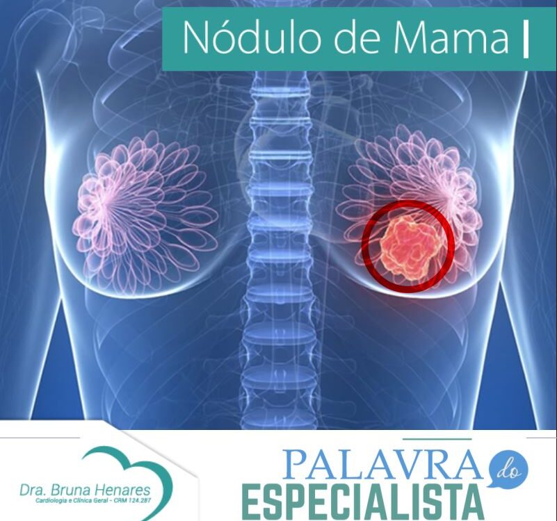 Nódulo de Mama