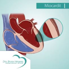 Miocardite