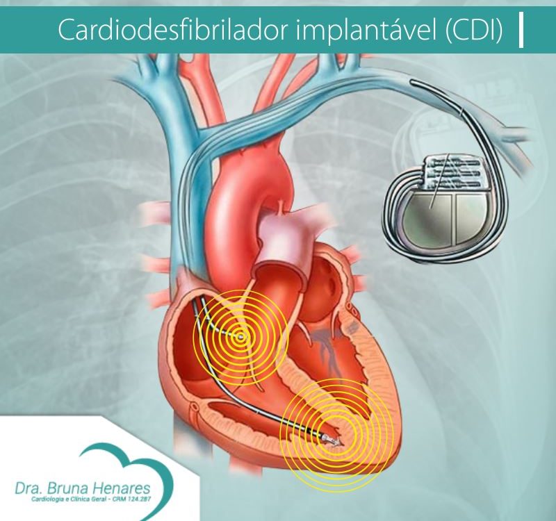 Cardiodesfibrilador Implantável