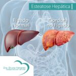 Esteatose Hepática