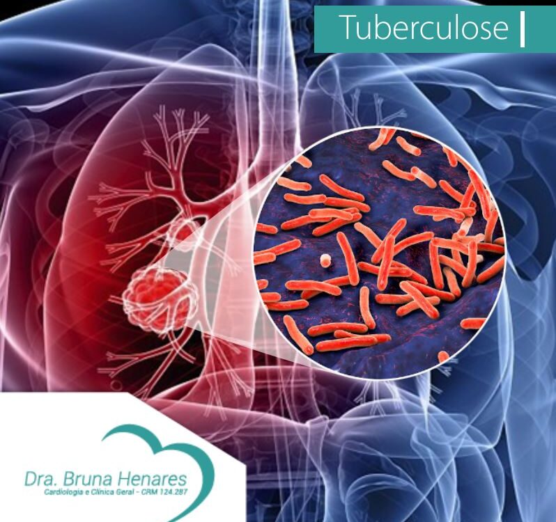 Tuberculose⁣⁣