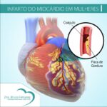 infarto do miocárdio