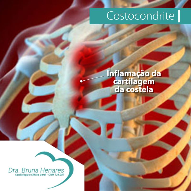 Costocondrite