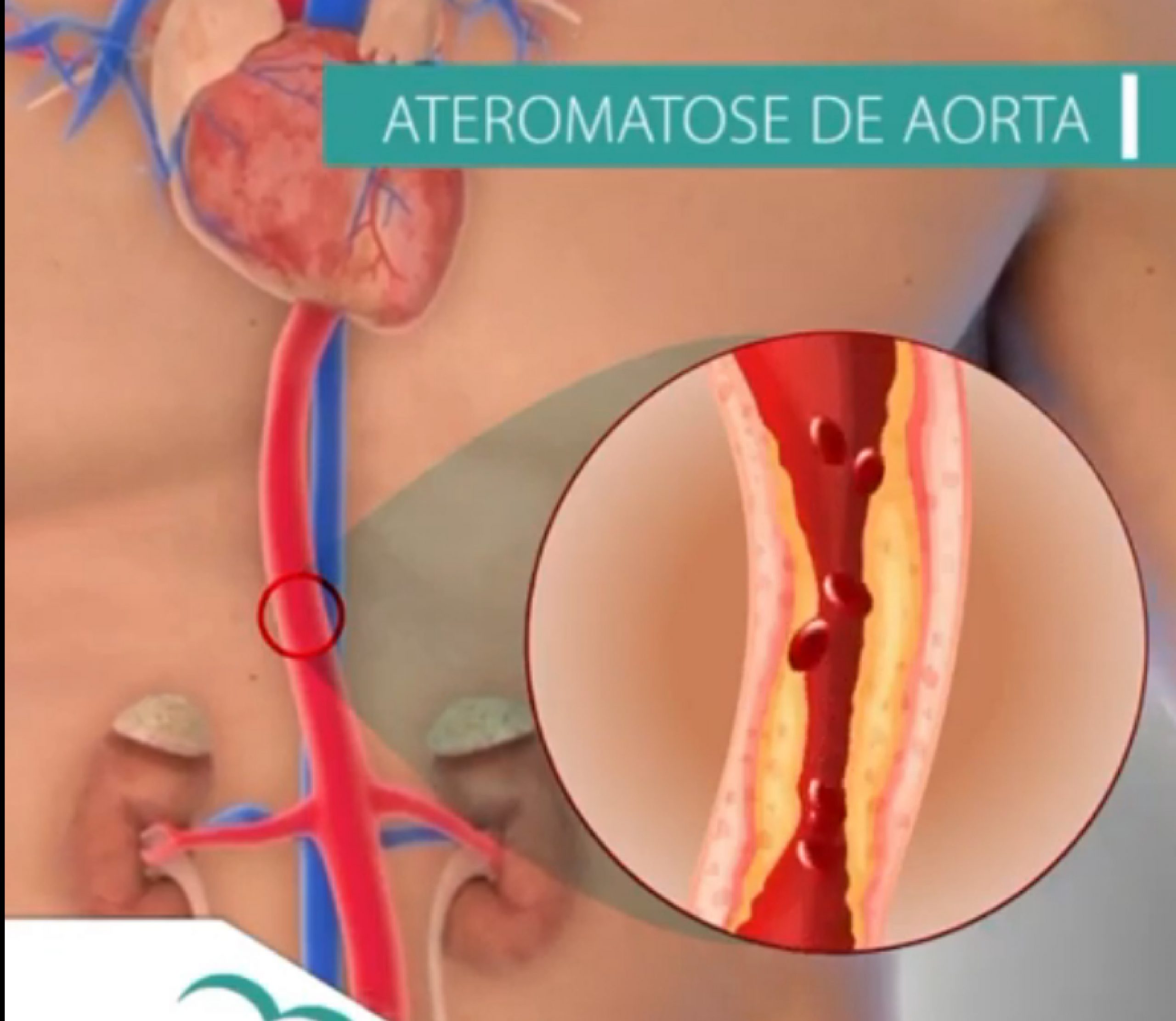 Ateromatose de Aorta - Dra. Bruna Henares