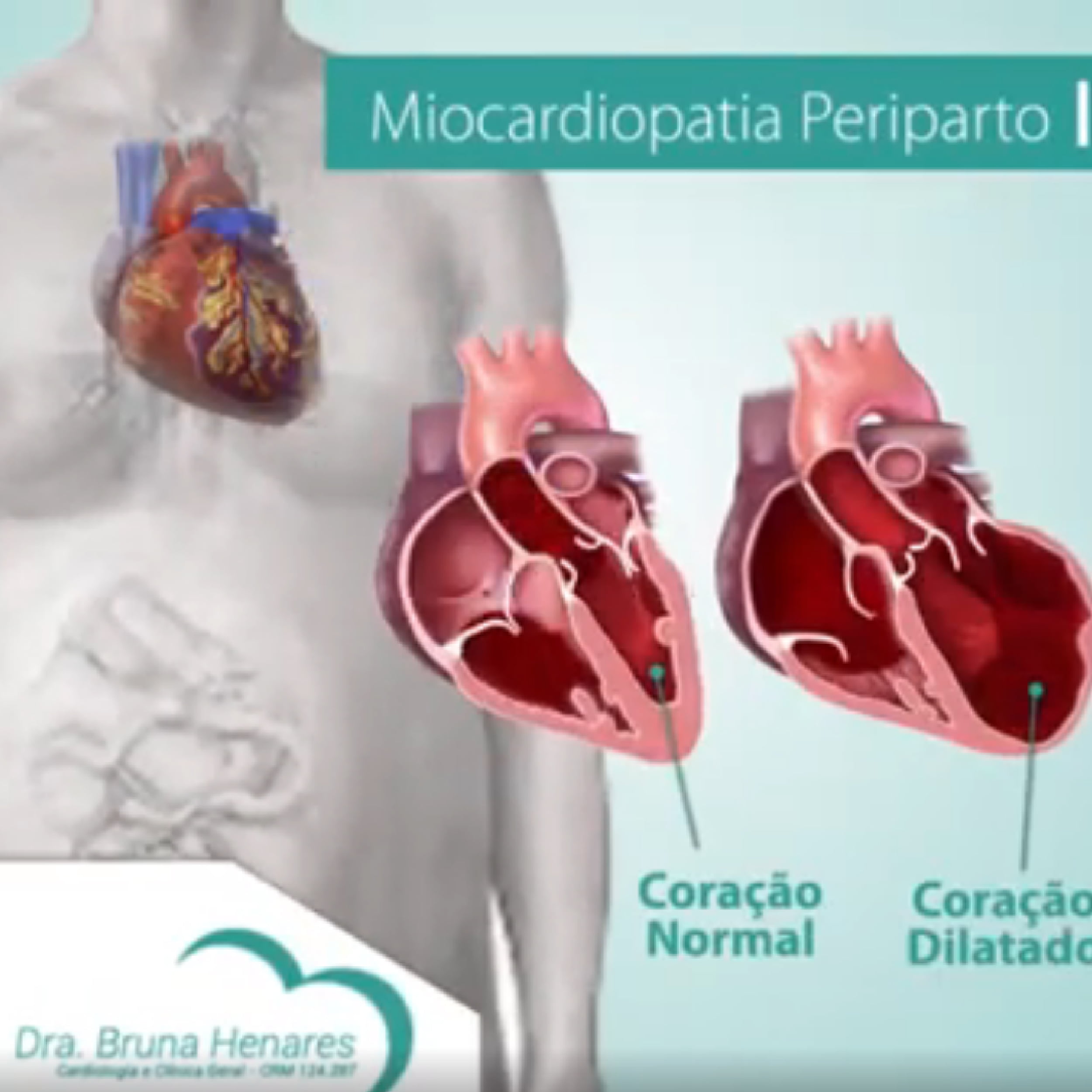 Miocardiopatia Periparto - Dra. Bruna Henares