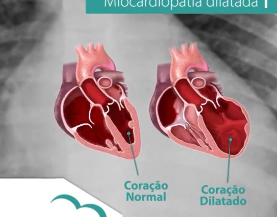 miocardiopatia dilatada – Dra. Bruna Henares