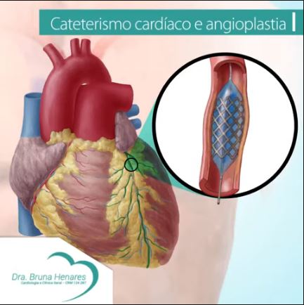 Cateterismo cardíaco e angioplastia