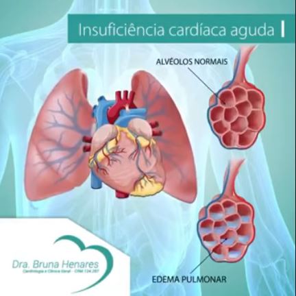 Insuficiência cardíaca aguda